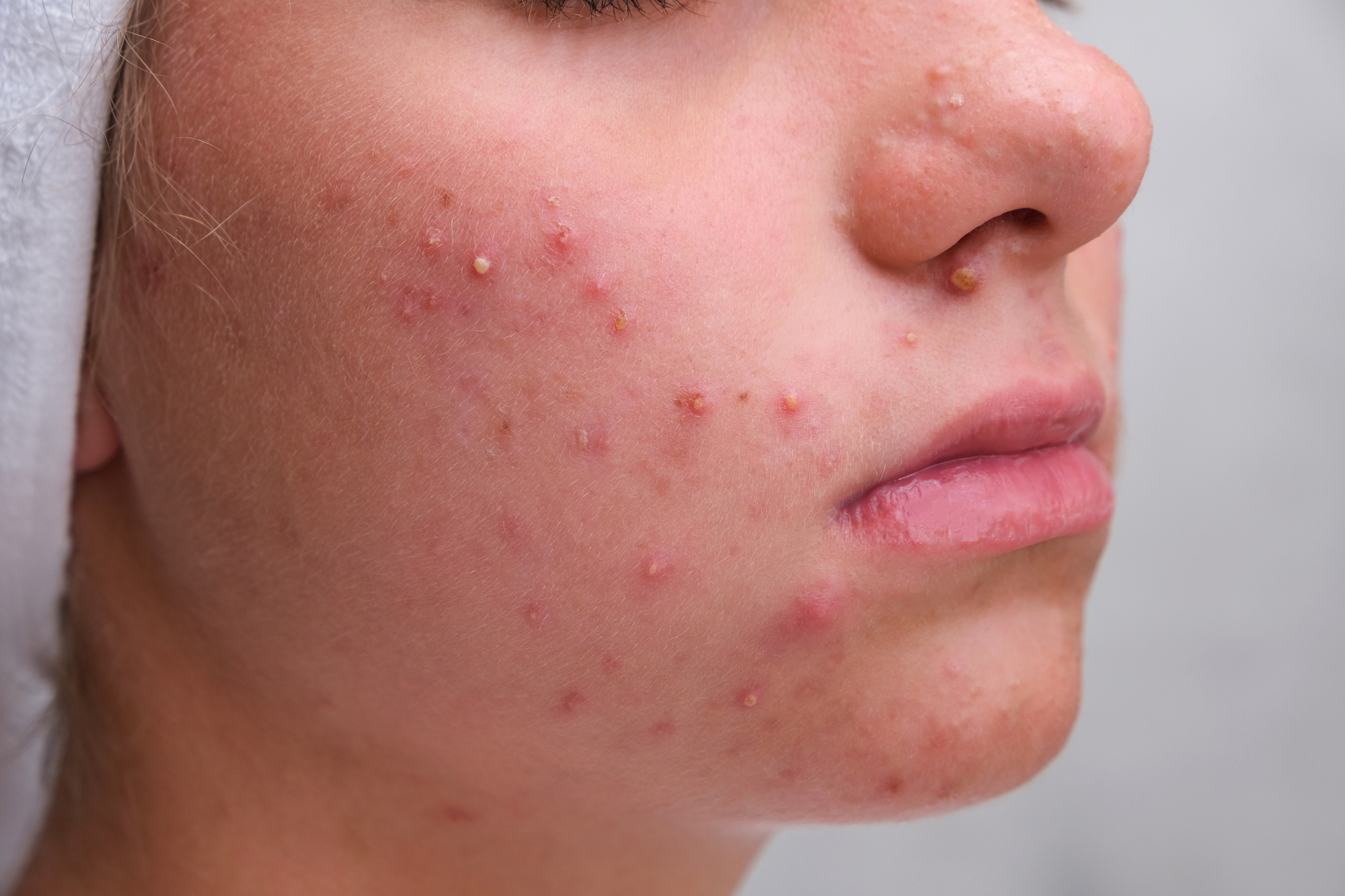 Acné et propolis