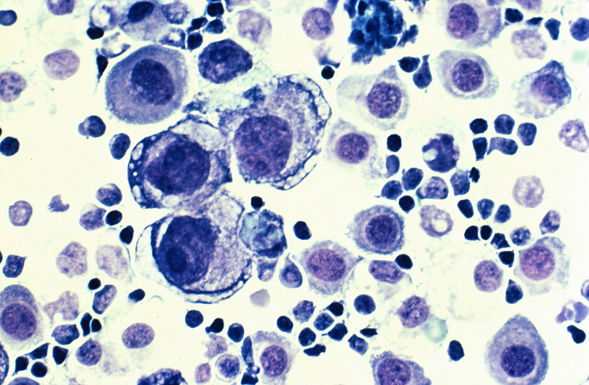 Infections-chroniques-brucellose